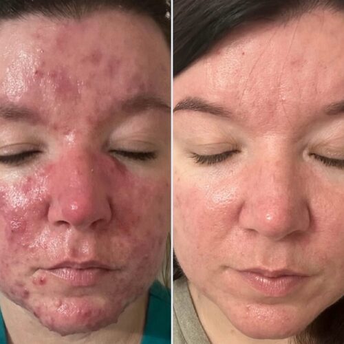 Before and after: active acne and redness visibly cleared