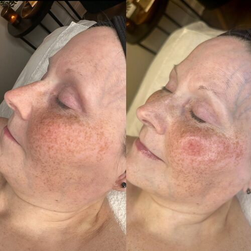 Before and after: sun damage and pigmentation visibly reduced