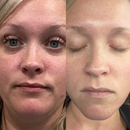 Before and after: skin tone evened and brightened by The Skin Canopy