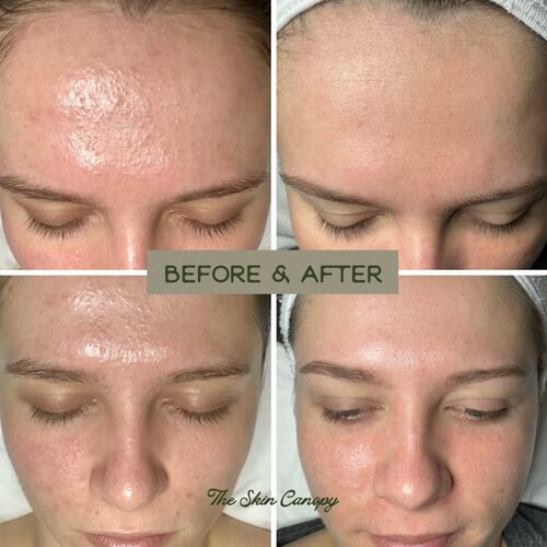 Before and after results of a facial treatment by The Skin Canopy